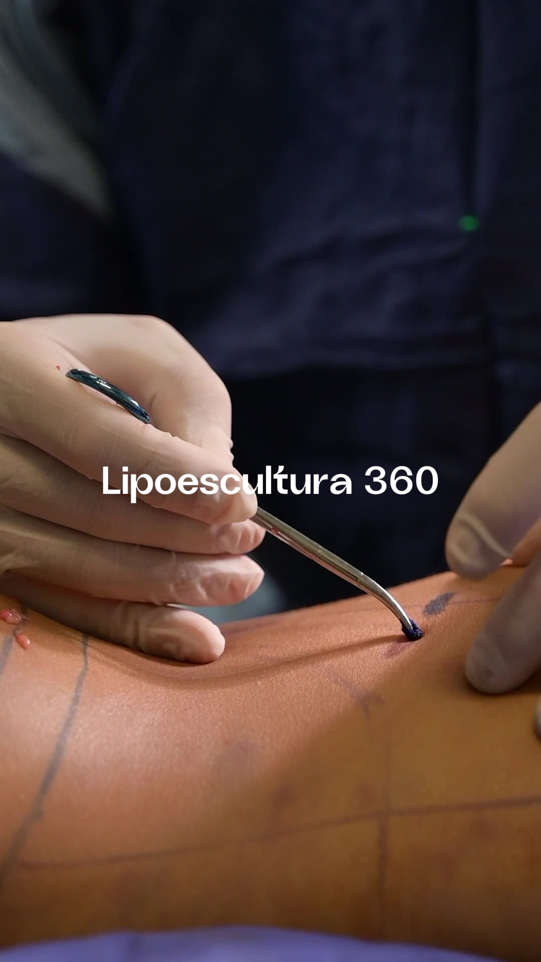 Reel del Dr. Matías Garavaglia, cirujano plástico — marketing de contenido médico AVA BLUE